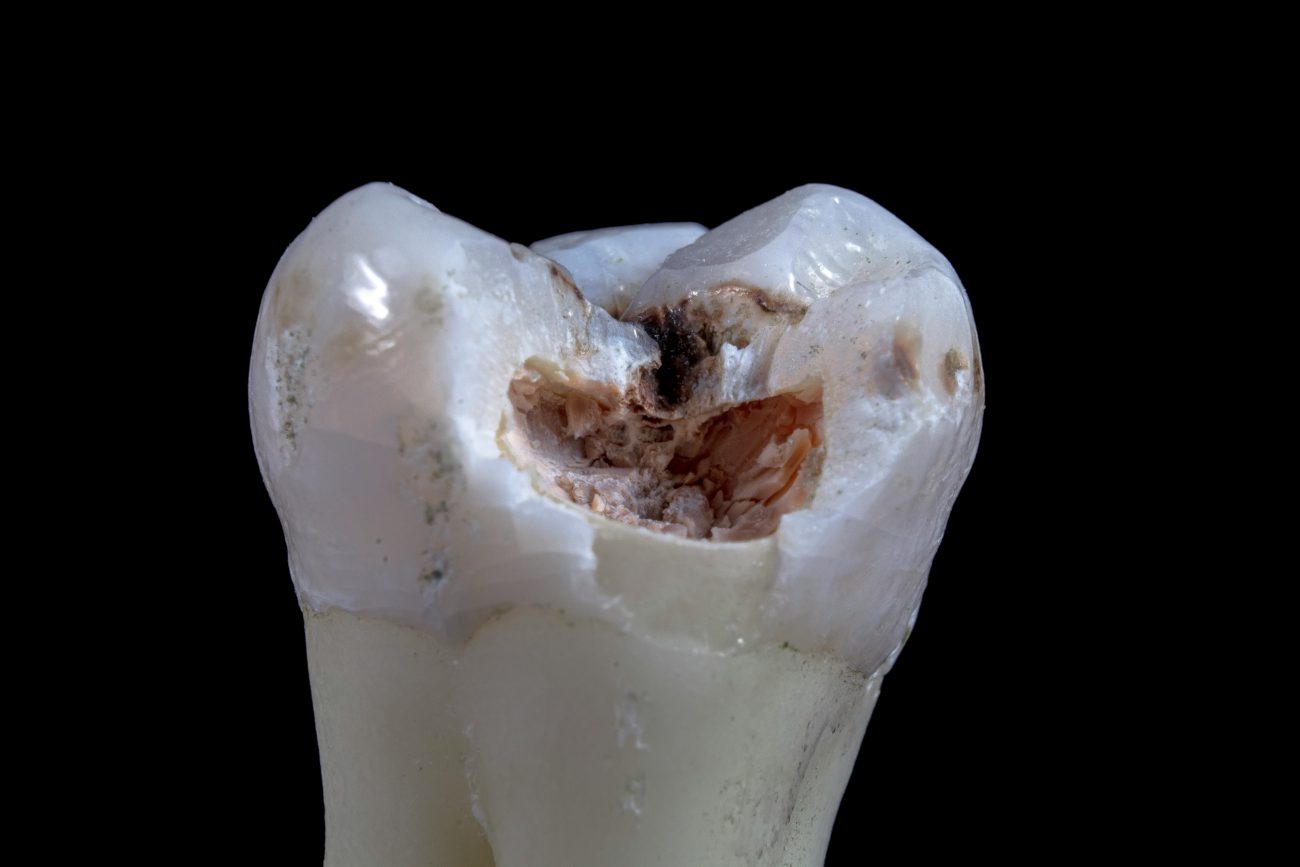 tooth model with a cavity